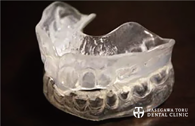 睡眠時無呼吸症候群の口腔内装置（OA：oral-appliance）作成｜愛知県名古屋市中区・栄【長谷川亨・歯科クリニック】名古屋栄の歯医者・歯科医院｜hasegawadental-nagoya.com