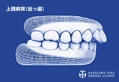 歯列矯正治療が可能な悪い歯並びのイメージ|出っ歯・上顎前突(じょうがくぜんとつ)|マウスピース矯正・インビザラインGo|愛知県名古屋市中区・栄|栄駅・矢場町駅近く【長谷川亨・歯科クリニック】名古屋栄の歯医者・歯科医院|hasegawadental-nagoya.com
