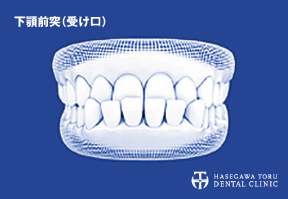 歯列矯正治療が可能な悪い歯並びのイメージ|受け口・下顎前突(かがくぜんとつ)|マウスピース矯正・インビザラインGo|愛知県名古屋市中区・栄|栄駅・矢場町駅近く【長谷川亨・歯科クリニック】名古屋栄の歯医者・歯科医院|hasegawadental-nagoya.com