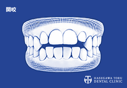 歯列矯正治療が可能な悪い歯並びのイメージ|開咬(かいこう)|マウスピース矯正・インビザラインGo|愛知県名古屋市中区・栄|栄駅・矢場町駅近く【長谷川亨・歯科クリニック】名古屋栄の歯医者・歯科医院|hasegawadental-nagoya.com