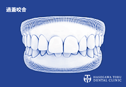 歯列矯正治療が可能な悪い歯並びのイメージ|過蓋咬合(かがいこうごう)|マウスピース矯正・インビザラインGo|愛知県名古屋市中区・栄|栄駅・矢場町駅近く【長谷川亨・歯科クリニック】名古屋栄の歯医者・歯科医院|hasegawadental-nagoya.com